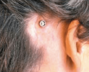 surgical bone anchored hearing aids (BAHA) hearing injury
